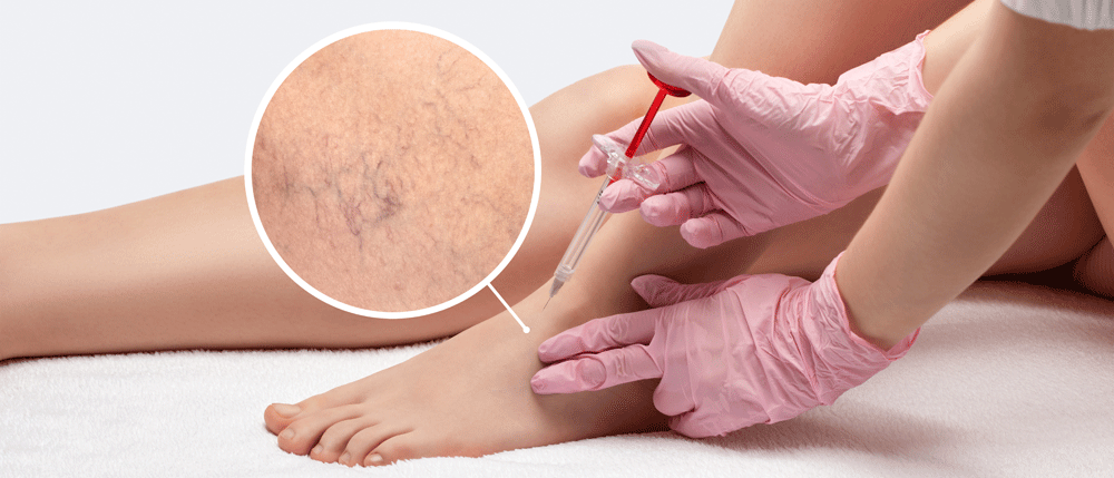 Sclerotherapy-2