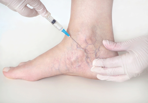 Sclerotherapy-4