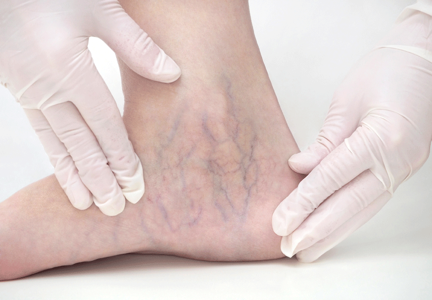 Sclerotherapy-intro