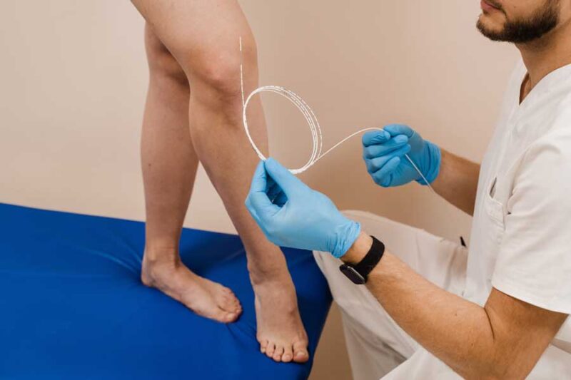 laser vein treatment los angeles laser vein treatment los angeles