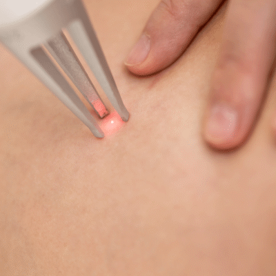 safe and effective laser vein treatment los angeles california safe and effective laser vein treatment los angeles california